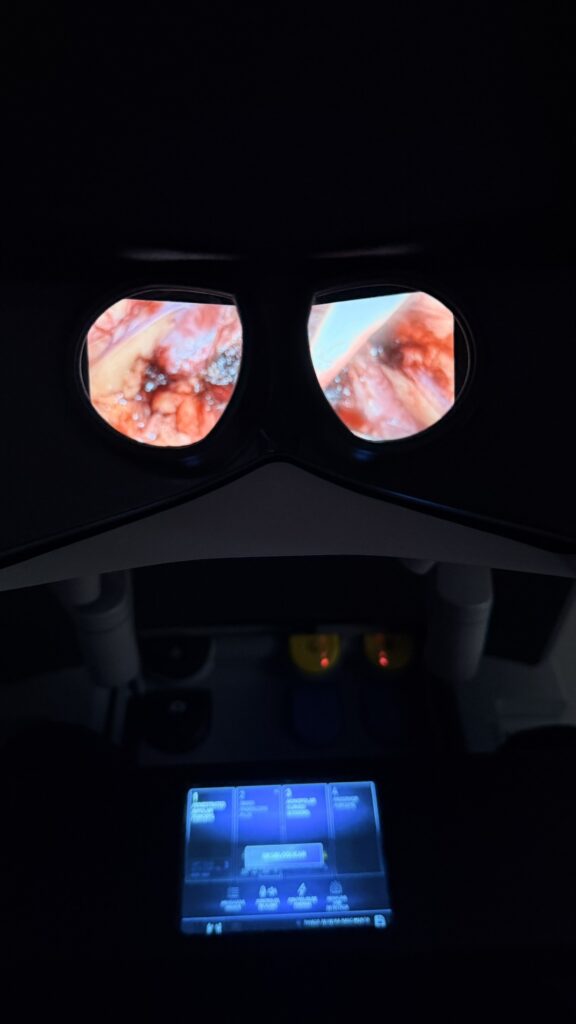 Dr. Thiago Teixeira realizando cirurgia robótica em urologia utilizando a console do robô cirúrgico Da Vinci.
